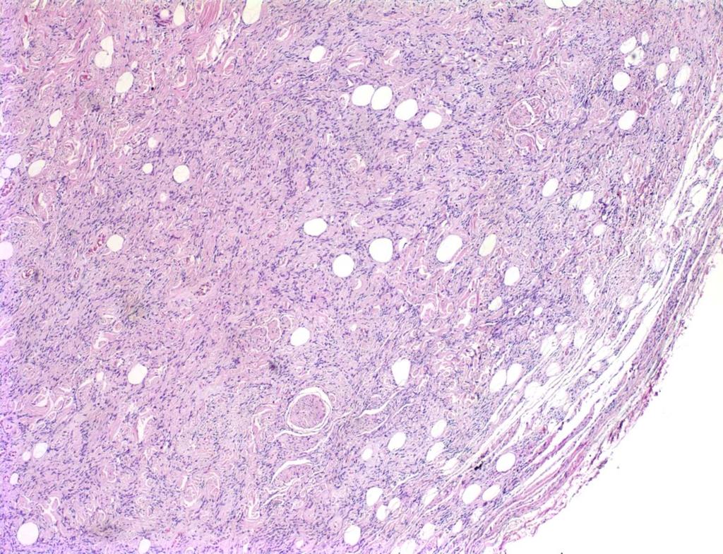 Medicl Pthology Koçıyık et l RESĐM 3: Olgu 2: ) Đyi sınırlı, ĐHL (HE X 40), ) Yerel lnlrd iğsi hücrelerin periferik sinir kılıfı tümörlerinde olduğu gii kıvrıntılı nukleus ship olduklrı dikkti