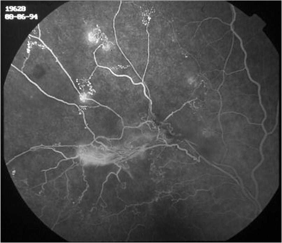 Erhan ÖZYOL ve ark. Resim 8. FA da sekel döneminde retina ven tıkanıklığı. Resim 9. Retina ven dal tıkanıklığı, argon laser ışık koagülasyonundan hemen sonra.