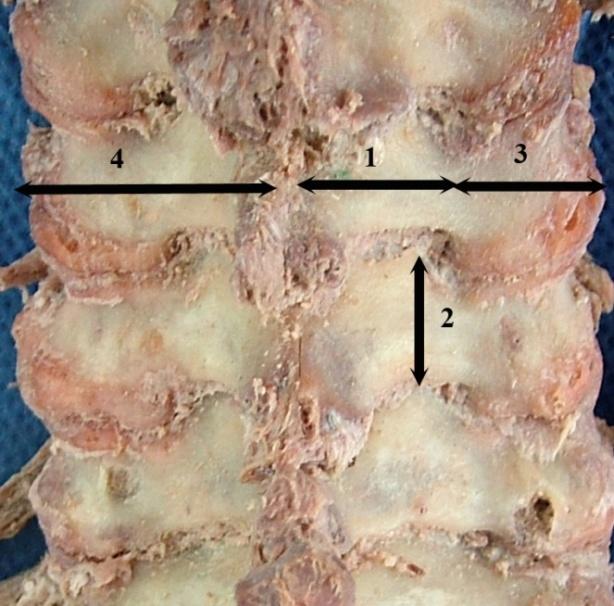 32 Şekil 2.2. Lamina arcus vertebrae nin genişliği (1), lamina arcus vertebrae nin yüksekliği (2), massa lateralis in genişliği (3), orta hat-massa lateralis arası mesafenin ölçülmesi (4).