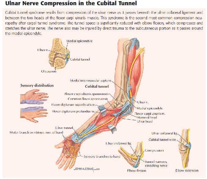 N. Ulnaris hasarı Humerus un medial epikondil kırıklarında, kübital tünelde, el bileğinde,