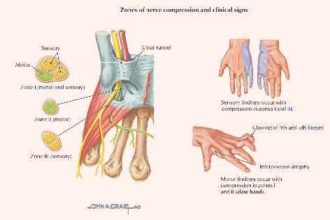 N. Ulnaris hasarı Ulnar sinir tarafından uyarılan lumbrikal ve interosseöz kaslardaki fonksiyon kaybı nedeniyle, yüzük