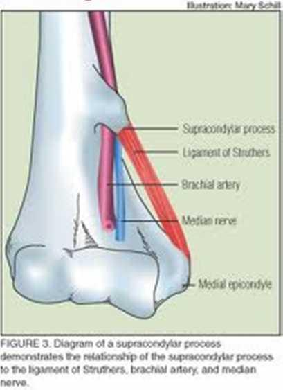 Proksimal N. medianus sıkışması (önkolda- en sık 2. sıkışma nedeni) Humerus un suprakondiler kırığı Pronator teres sendromu (m.