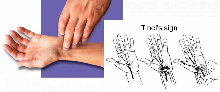 Karpal tünel Sendromu Tanı Testi Tinel belirtisi; el bileğinin palmar yüzü üzerindeki transvers karpal ligament üzerine