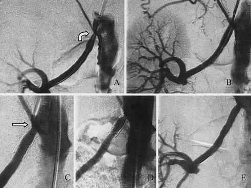 Resim 3. A. Soliter sa böbrek selektif anjiyografisi. Renal arter ostiumunda %70 dolay nda darl k görülüyor (ok). Renal arterin inferiora seyrinden dolay, giriflim yolu olarak aksiller arter seçildi.