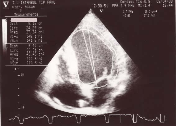Vaka Total Kardiyomegali Ciddi sol ventrikül disfonksiyonu (EF % 25) SV diffüz belirgin hipokinezi Mitral yetersizliği +3 Aort kapak dejenerasyonu,
