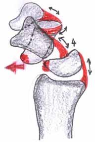 Radyoskafoid-kapitat bağ dorsal translasyonu sınırlandırır (4).