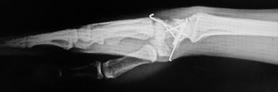 Dorsal perilunat kırıklı-çıkık olgularında, hafif el bilek fleksiyonu ile birlikte kapitata dorsalden nazikçe bası uygulaması tavsiye edilir.