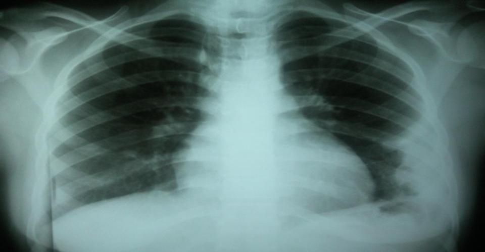 348 Resim 1: Postero anterior akciğer grafisinde; bilateral avaskülerizasyon, solda
