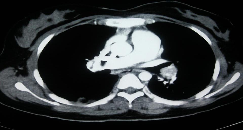 Resim 2: Spiral toraks bilgisayarlı tomografinin mediasten incelemesinde; sol ana
