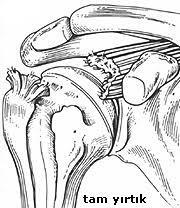 KAS (TAM) YIRTILMASI Kas yırtılması birdenbire olur ve bununla ilgili kas gruplarında şiddetli ağrı eşlik eder.