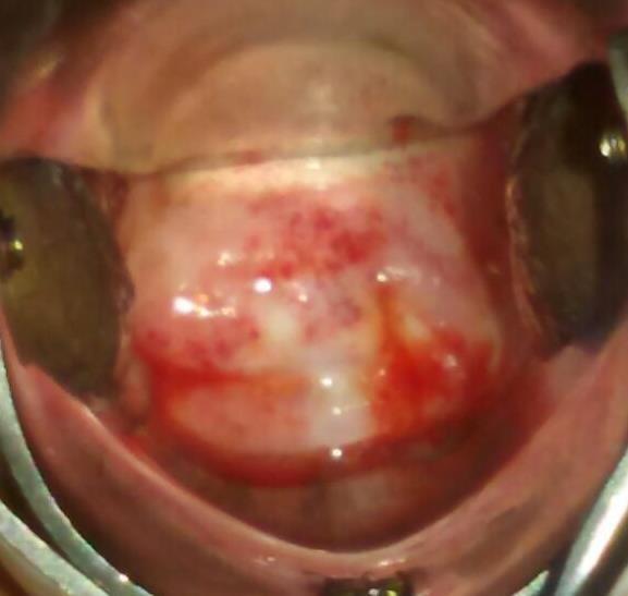 25%): Telangiectasia