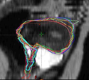 Case 1 IB2 all contours - MRI CTV1 0.