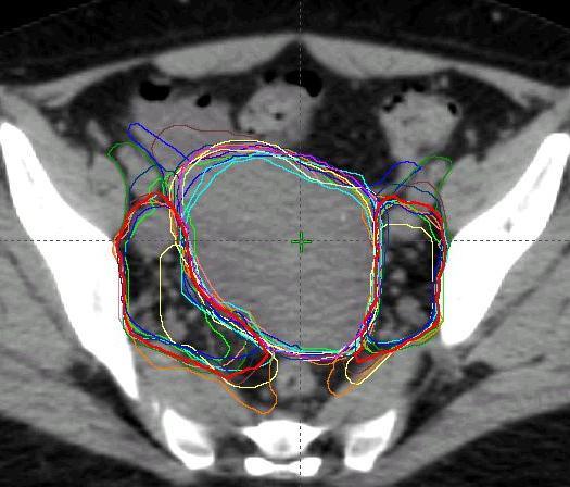 Case 2 IIIB all contours - CT CTV1 0.