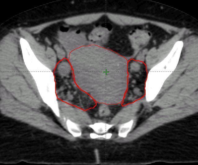 CT Case 2