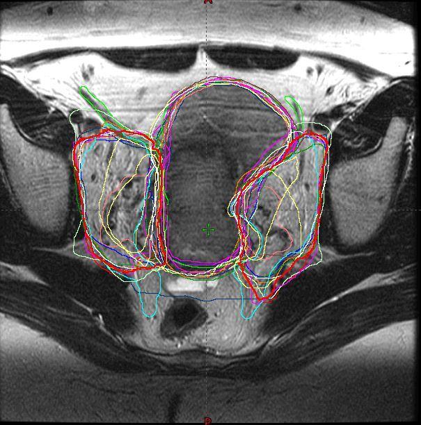 MRI Case 2 - IIIB CTV1 0.