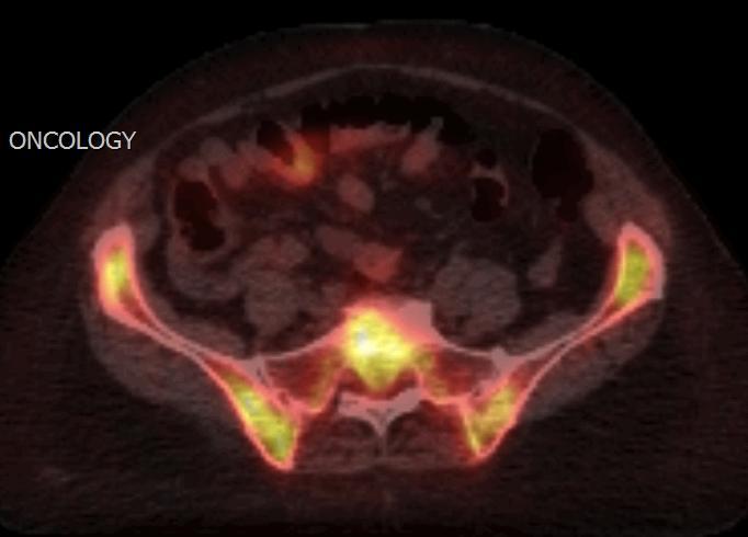 18FLT-PET for Functional Bone Marrow Imaging
