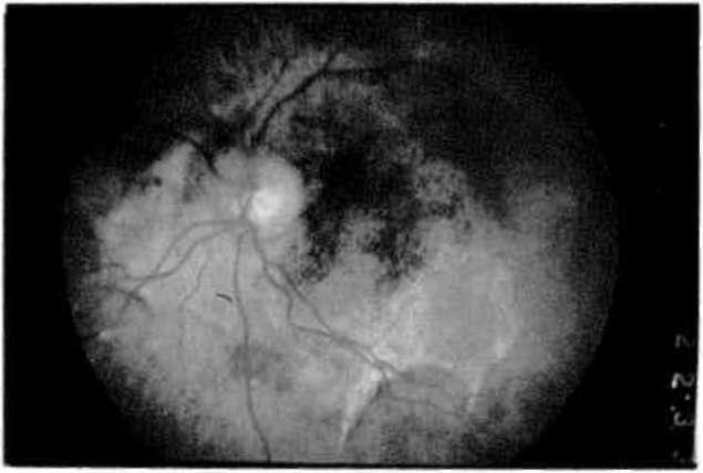 Gliotlk dekole retina klinik olarak beyaz retrolental kitle olarak izlenir (38-43). Prognoz nlsbeten İyidir. Şekil 4 b.