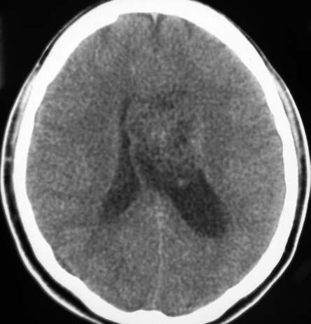 İntravenriküler Santral Nörositoma: Olgu Sunumu OLGU SUNUMU On dokuz yaşında, erkek hasta yüksekten düşme ve kafa travması öyküsü ile kliniğimize yatırıldı. Nörolojik muayenesinde özellik saptanmadı.