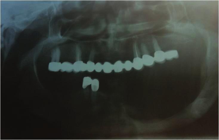 Postoperatif 20 aylık takibi sonucunda lezyon bölgesinin tamamen iyileştiği ve herhangi bir tekrar olmadığı görüldü (şekil 5). Şekil 5. Postoperatif 20. aydaki panoramik görünüm. Şekil 3.