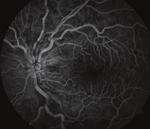 137 Resim 3a,b: Fundus floresein anjiografi (a) tanı anında erken faz, (b) tanı anında geç faz. Gastroenteroloji, kardiyoloji ve hematoloji bölümlerinden konsültasyon istendi.