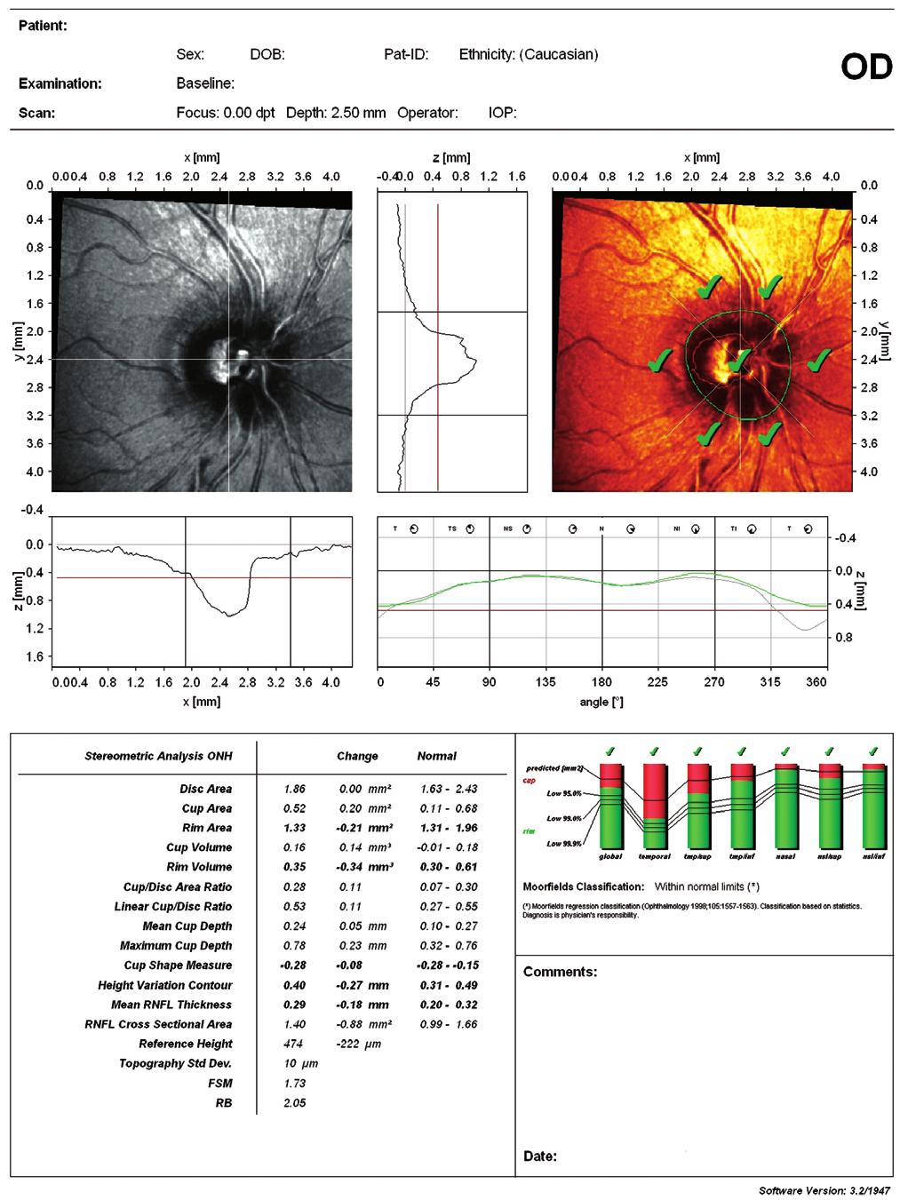 138 Ülseratif Kolitli ir Hastada Ortaya Çıkan ve İntravitreal Deksametazon İmplant ile Tedavi... Resim 4a,b: Heidelberg retinal tomografi (a) sağ göz, (b) sol göz.