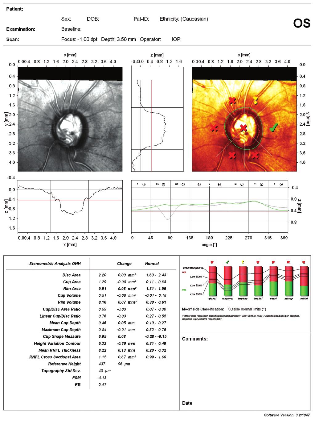 Hastamızda tespit edilen MTHFR C677T ve Prothrombin G20210 heterozigot mutasyonlarının da retinal ven tıkanıklıklarına neden olabileceği bildirilmiştir.