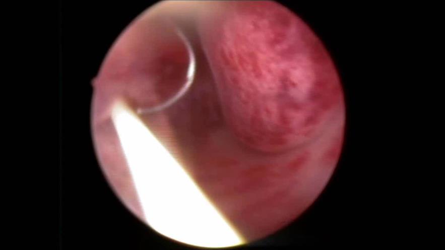 Operatif H/S : Endometrial Polip Büyük endometrial poliplerde : Loop koter