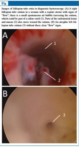 Tubal Patensin Belirlenmesinde HS yöntemi Fallopian