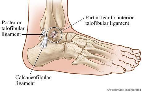 Ayak Bilek Burkul ası Ge ellikle a ağlar sıra ile ırtılır - 1. Anterior talofibular (ATFL) - 2.