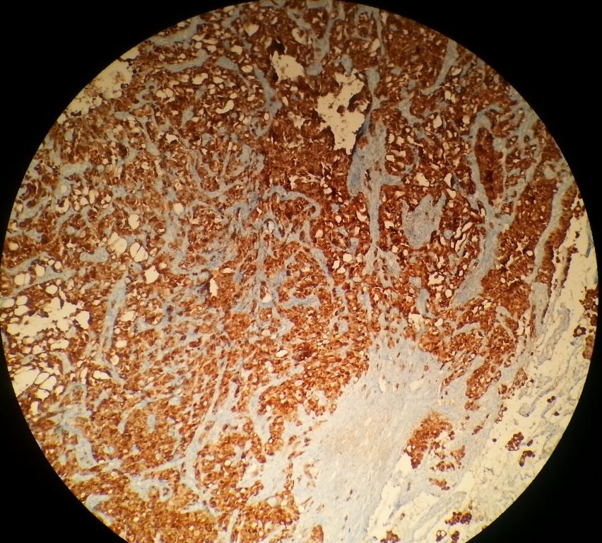 Patoloji sonucu malign mezotelyoma olarak raporlandı. Parietal plevrada, visseral plevrada ve nodülde tümör varlığı saptandı.