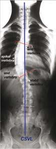 98 Figure 15: Complete development in children can be monitored by the degree of closure of the ends of the epiphysis on the iliac crest, which is called Risser s sign.