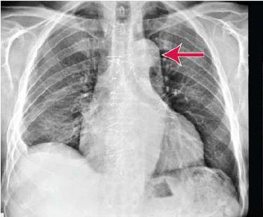 Aort diseksiyonu Aort diseksiyonu Ateroskleroz Sternum arkasından sırta yayılan Yırtıcı vasıfta ağrı Kontrolsüz