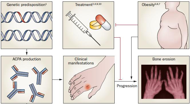 Romatoid Artrit= Farklı mekanizmaların ortak bir yol kullanarak benzer kli Az eklemi tutmuş / Çok eklemi tutmuş CCP pozitif / CCP negatif RF pozitif / RF negatif