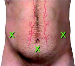 5 %75 hastada Grabau et al Hepatology 2004 4729 parasentezde 9 ciddi kanama (%019) ve 7 sinde ölüm (%015) bildirilmiş.