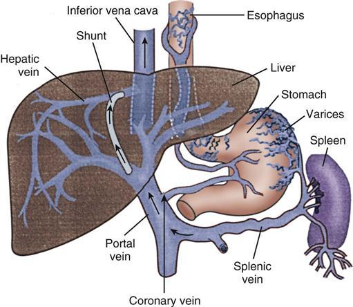 TIPS (Transjugular Intrahepatic Portosystemic Shunt) EASL CPG J Hepatol 2010 Runyon BA Hepatology 2009, Bai et al WJG 2015 TIPS refrakter assit tedavisinde etkili Assit tekrarlamaz ve HRS gelişmez