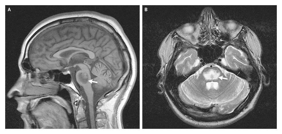 Ozmotik demiyelinasyon sendromu (Central pontine demyelinolysis) (A 26-year-old man with a history of chronic alcohol