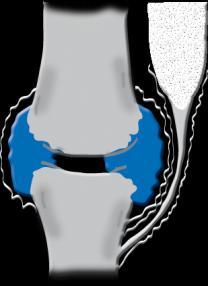 Romatoid artrit inflamatuvar bir durumdur Birçok yaşlı hasta osteoartrit nedeniyle NSAİİ kullanır Eklem yüzeyine kadar yayılmış İnflame sinovium Sinovial sıvı Kemik Kas Kemiğin köşesinde erozyon