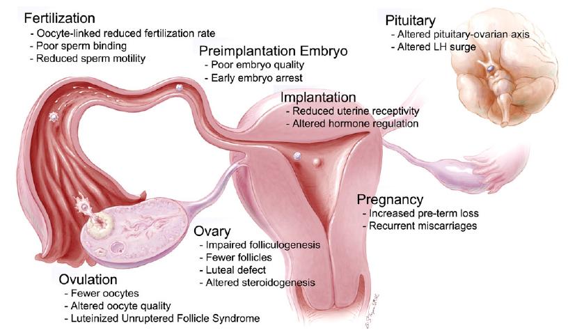 ENDOMETRİYOZİS İLİŞKİLİ İNFERTİLİTENİN PATOJENİK MEKANİZMASI Follikülogeneziste değişiklikler