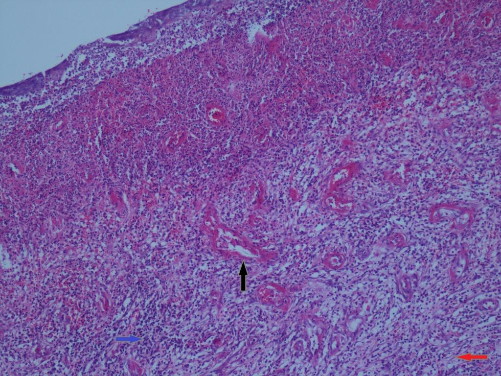 Şekil 2 : Yüzeyde granülasyon dokusu, altta fibroblastlar (kırmızı ok), inflamatuar hücreler (mavi ok) ve damar yapılarından (siyah ok) oluşan