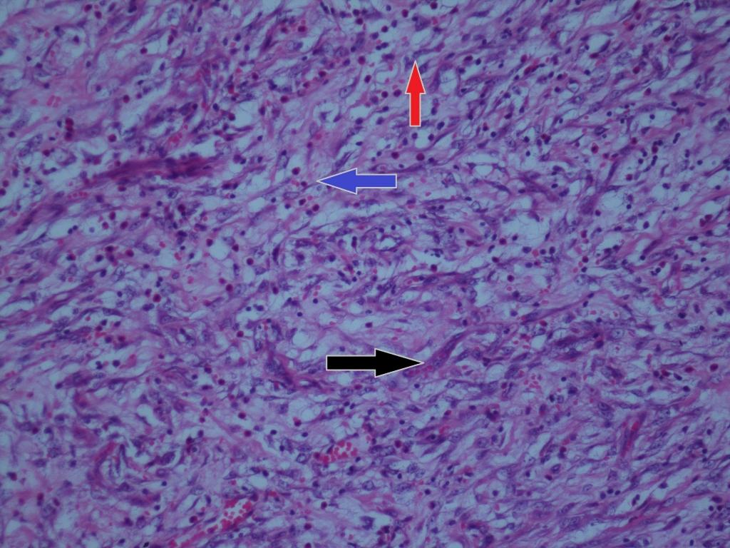 İmmünohistokimyasal incelemede; CD34 ile damarlarda (+) (Şekil 4), Vimentin ile damarlarda (+) ve lezyonda fokal (+) boyanma (Şekil 5), CD117,