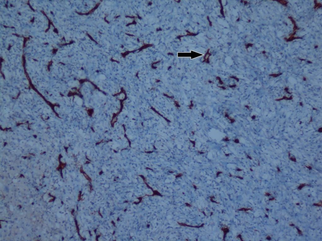 Şekil 4 : İmmunhistokimyasal CD 34 ile damarlarda pozitif boyanma (ok), x10 Şekil 5 : İmmunhistokimyasal vimentin ile fibroblast ve damarlarda pozitif boyanma (ok) Tartışma