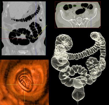 CT KOLONOGRAFİ POLİP SURVEYLANSINDA AVANTAJLI BİR ARAÇ 1- Minimal invaziv, kısa süreli ve ağrısız 2- >10mm lezyonlar için sensitivite:%85-93 spesivitesi:%97 3-6-9mm lezyonlar