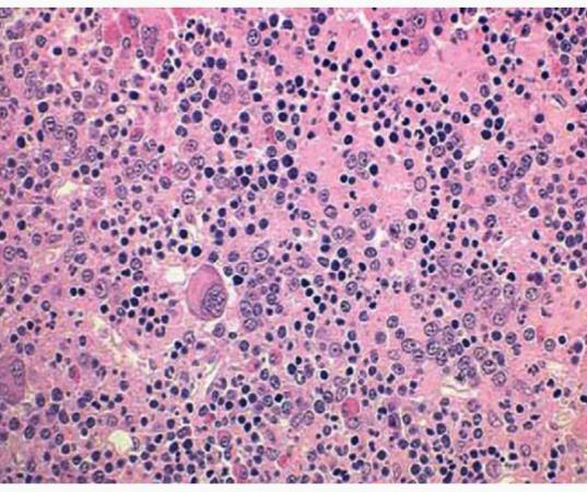 Polisitemia Vera(PV) Olgun kırmızı kan hücrelerinin aşırı üretimiyle karakterize klonal bir hastalıktır.