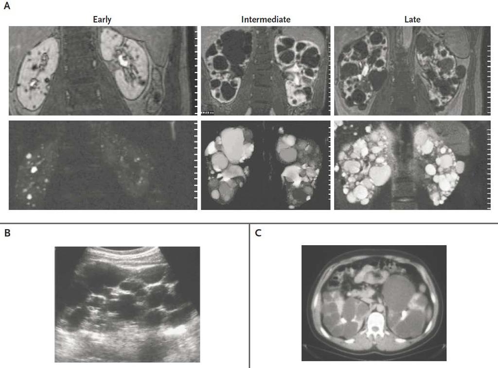 Otozomal Dominant Polikistik Böbrek Hastalığında