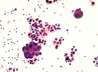 DAĞLI A F et al: Pleural Fluid Cytology Türk Patoloji Dergisi/Turkish Journal of Pathology is therefore a rapid, effective and noninvasive method to determine the etiology (6,7).