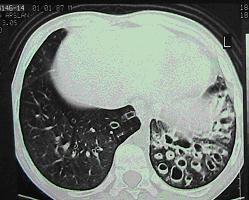 Masif hemoptizi Akut ASY enfeksiyonları Trakeobronşit Pnömoni Akciğer absesi