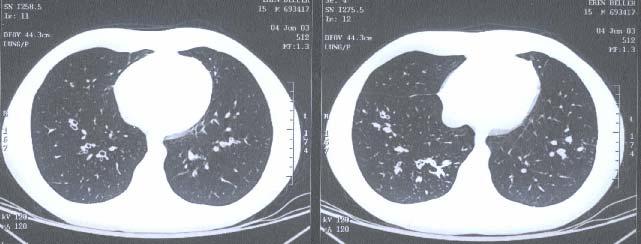 Bronşiektazi/Kistik fibroz Tuberküloz Trakeobronşiyal vasküler anomaliler
