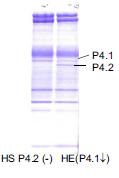 Eritrosit membran bozukluklarında Tanı OF EMA HS HPP OHSt DHSt OIHA CDA-II N/ N/ tarama testleri Polyacrylamide gel electrophoresis CDA-II; hafif hemolitik anemi, splenomegali, mikrosferositler ve OF