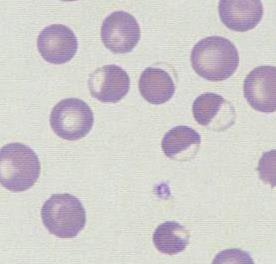 taşıyıcılığı Anstabil hemoglobinler (OD) Heinz body hemolitik anemiler İsopropanol