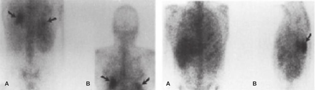 Pneumocystis jirovecii Pnömonisi Pneumocystis jirovecii Pneumonia Resim 3. Pnömosistis pnömonisi saptanan hastanın galyum sintigrafisi görüntüleri.